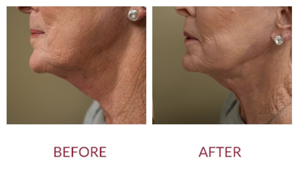 Co2 Laser Resurfacing Before & After Gallery - Patient 148589285 - Image 1