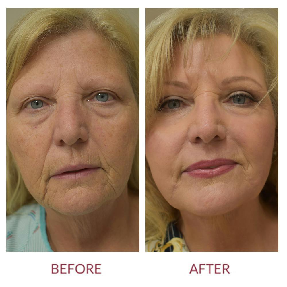 Facelift Before & After Gallery - Patient 148589275 - Image 1