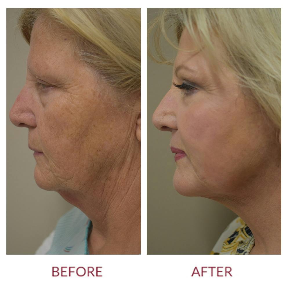 Facelift Before & After Gallery - Patient 148589275 - Image 3