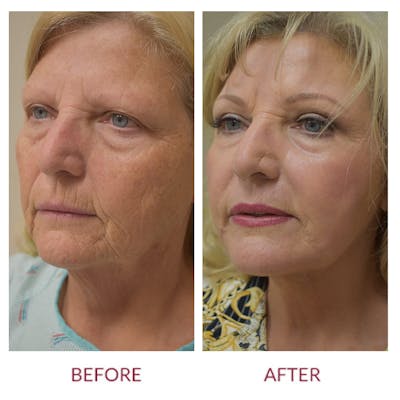 Facelift Before & After Gallery - Patient 148589275 - Image 2