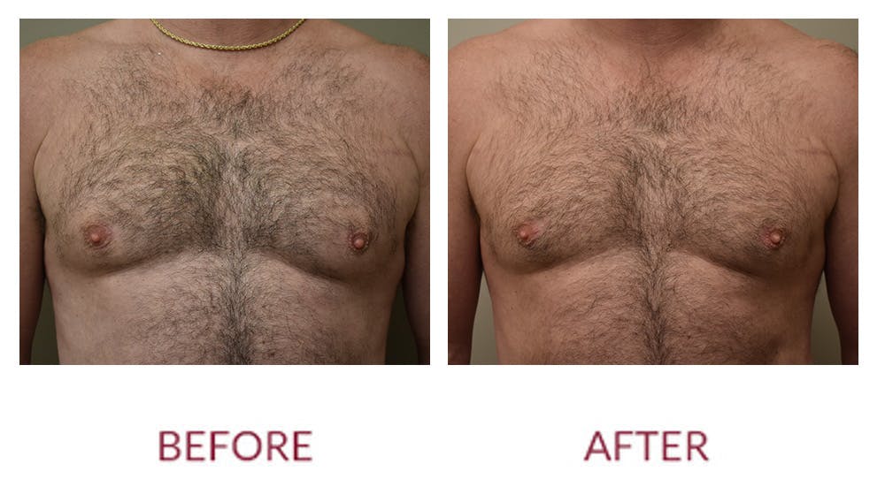 Gynocomastia Before & After Gallery - Patient 148589282 - Image 1