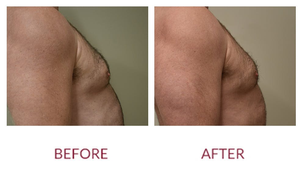 Gynocomastia Before & After Gallery - Patient 148589282 - Image 3