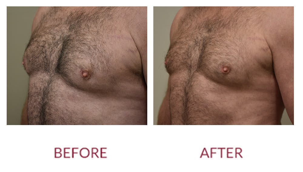 Gynocomastia Before & After Gallery - Patient 148589282 - Image 2