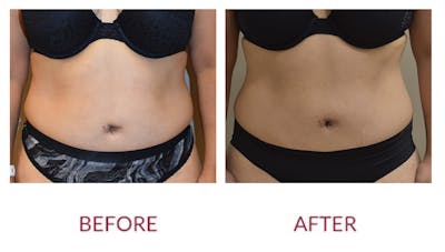 Tummy Tuck Before & After Gallery - Patient 148589261 - Image 1