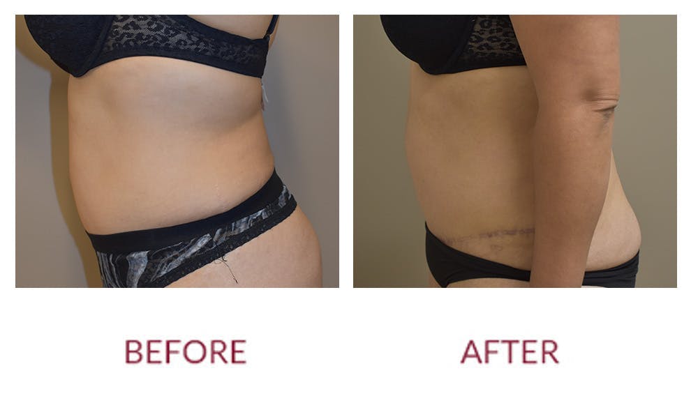 Tummy Tuck Before & After Gallery - Patient 148589261 - Image 3