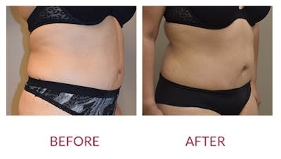 Tummy Tuck Before & After Gallery - Patient 148589261 - Image 2