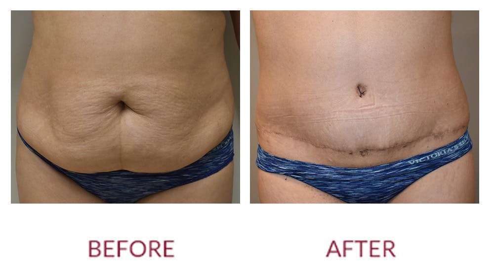 Tummy Tuck Before & After Gallery - Patient 148589260 - Image 1