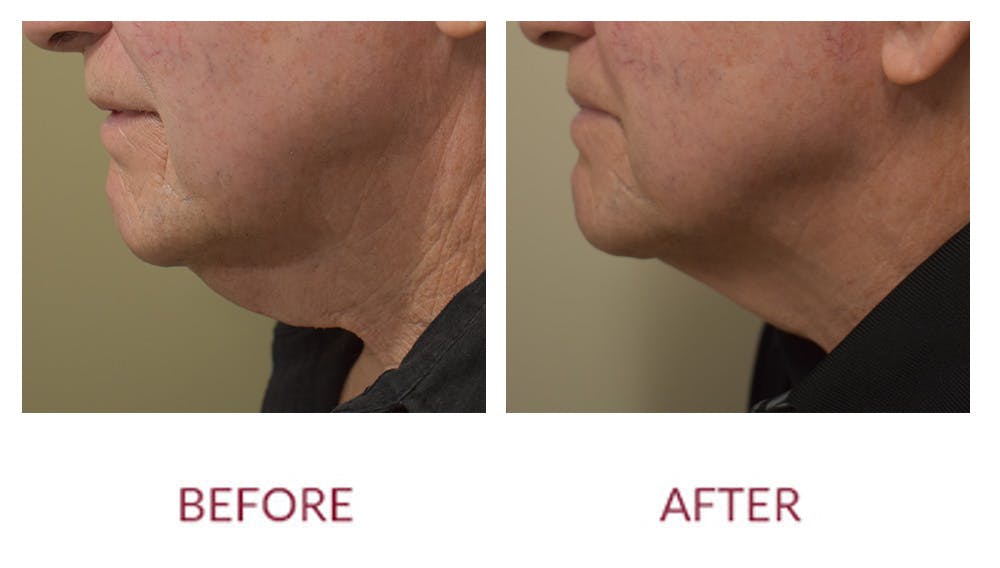Chin Augmentation Before & After Gallery - Patient 148702348 - Image 1