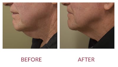 Chin Augmentation Before & After Gallery - Patient 148702348 - Image 1