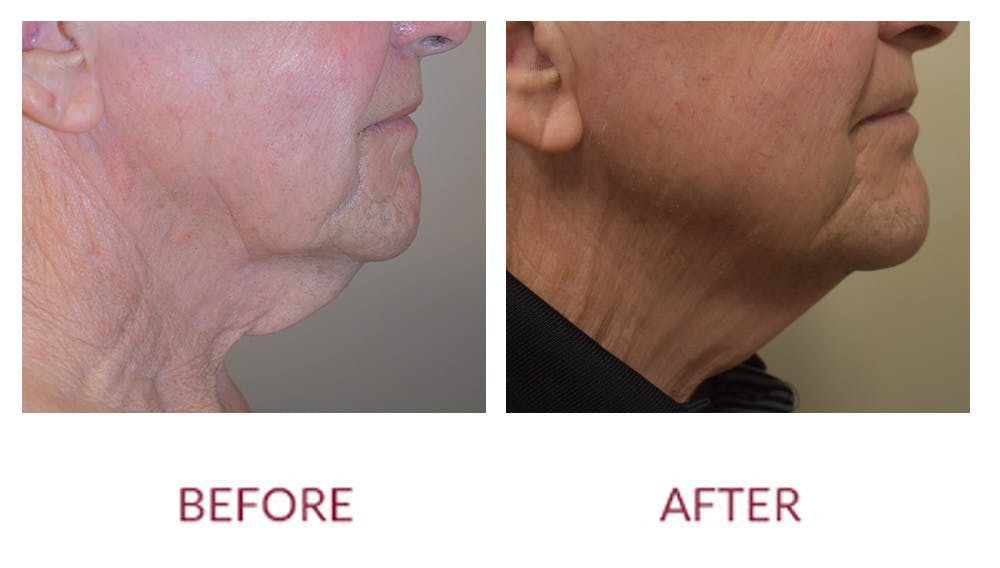 Chin Augmentation Before & After Gallery - Patient 148702348 - Image 2