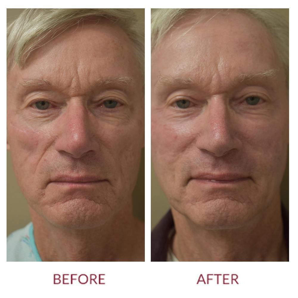Co2 Laser Resurfacing Before & After Gallery - Patient 148702351 - Image 1