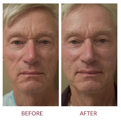 Co2 Laser Resurfacing Before & After Gallery - Patient 148702351 - Image 1