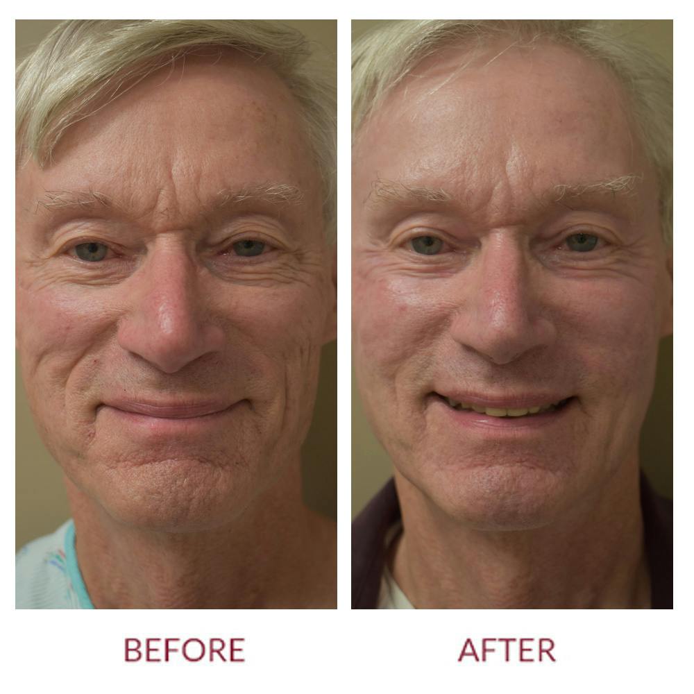 Co2 Laser Resurfacing Before & After Gallery - Patient 148702351 - Image 2