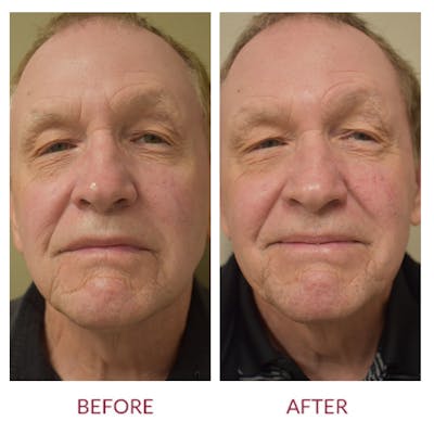 Facelift Before & After Gallery - Patient 148702376 - Image 1