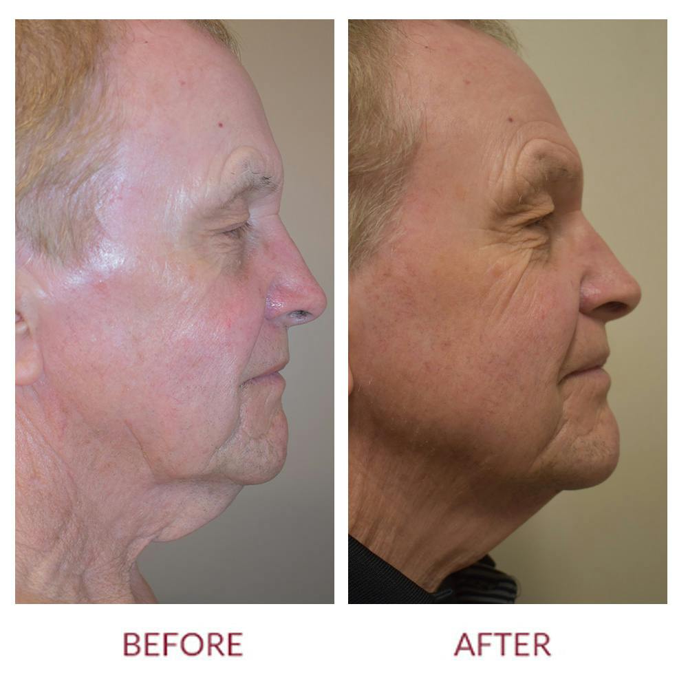 Facelift Before & After Gallery - Patient 148702376 - Image 2