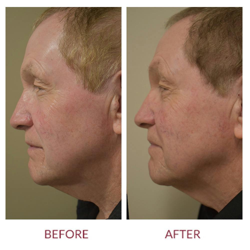 Co2 Laser Resurfacing Before & After Gallery - Patient 148702383 - Image 3