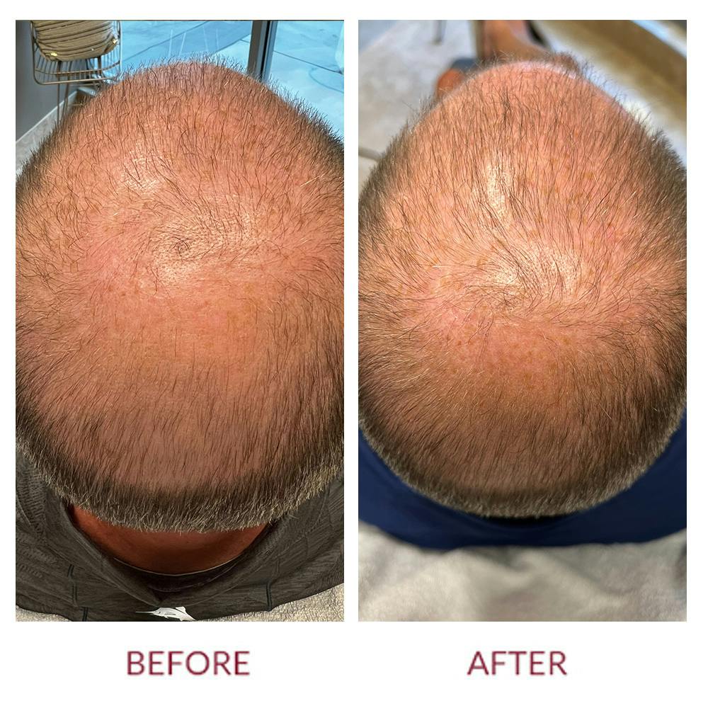Hair Restoration Before & After Gallery - Patient 148702387 - Image 1