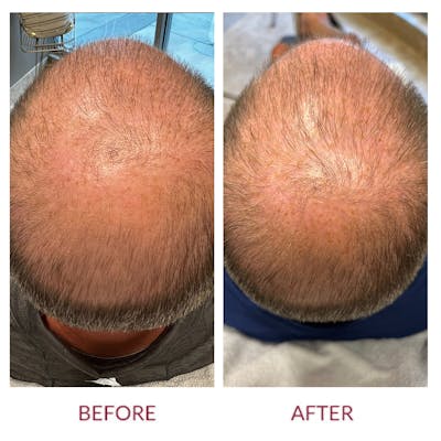 Hair Restoration Before & After Gallery - Patient 148702387 - Image 1