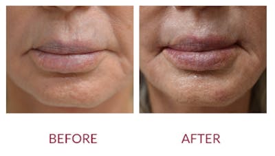 Lip Lift Before & After Gallery - Patient 148702388 - Image 1