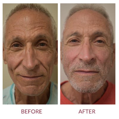 Nasolabial Fold Before & After Gallery - Patient 148702395 - Image 1