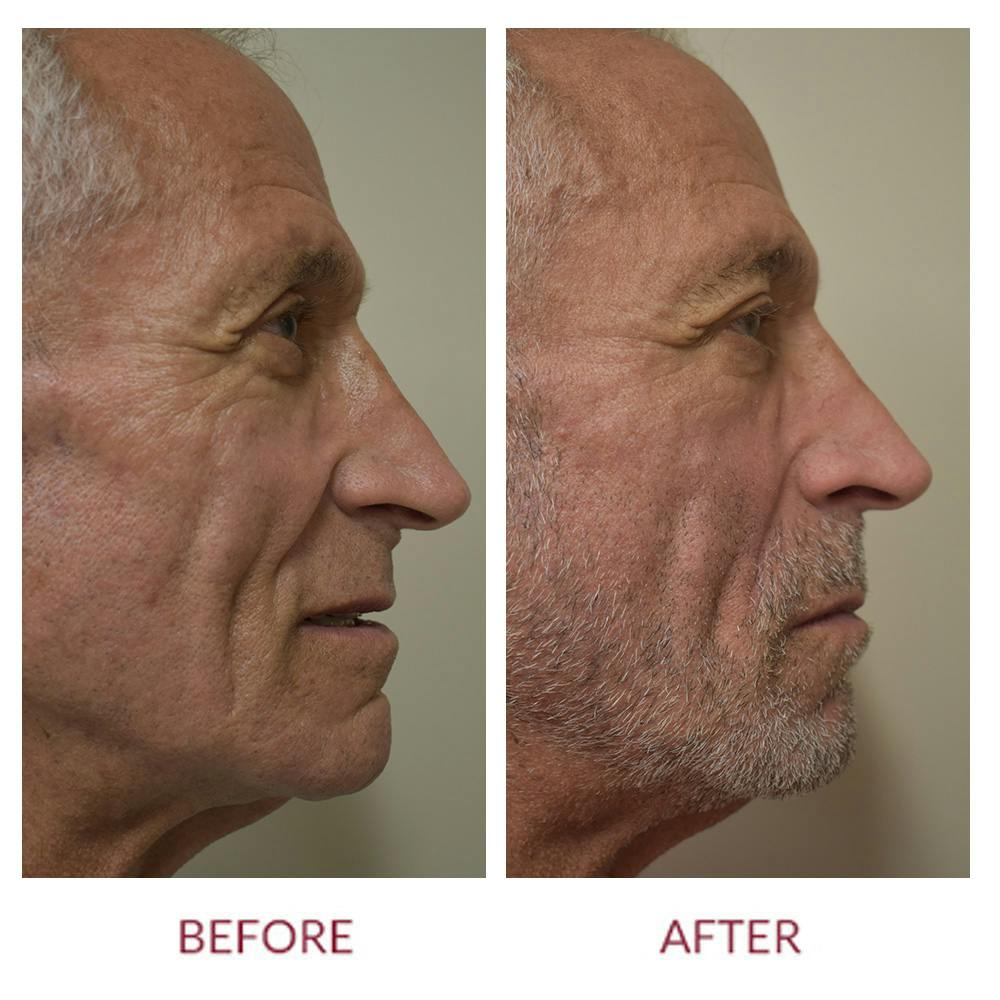 Nasolabial Fold Before & After Gallery - Patient 148702395 - Image 6