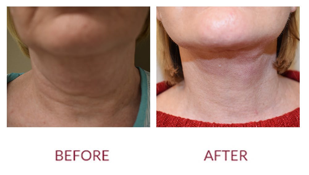 Neck Lift Before & After Gallery - Patient 148702413 - Image 1
