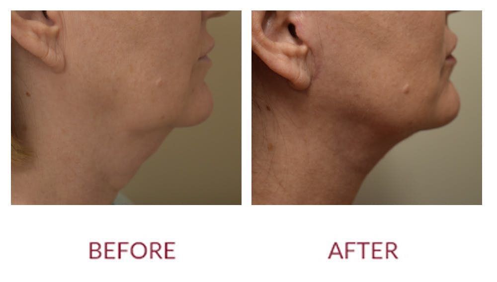 Neck Lift Before & After Gallery - Patient 148702413 - Image 2