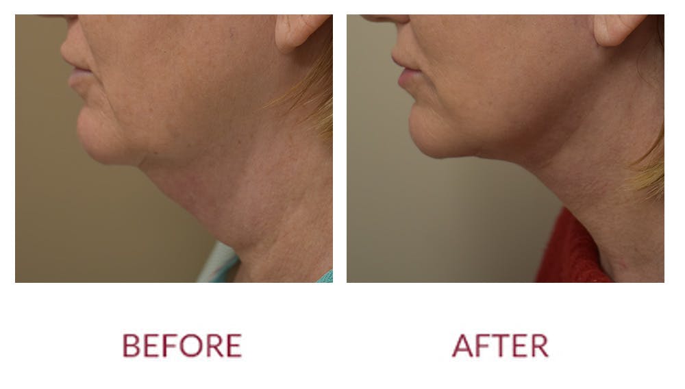 Neck Lift Before & After Gallery - Patient 148702413 - Image 3