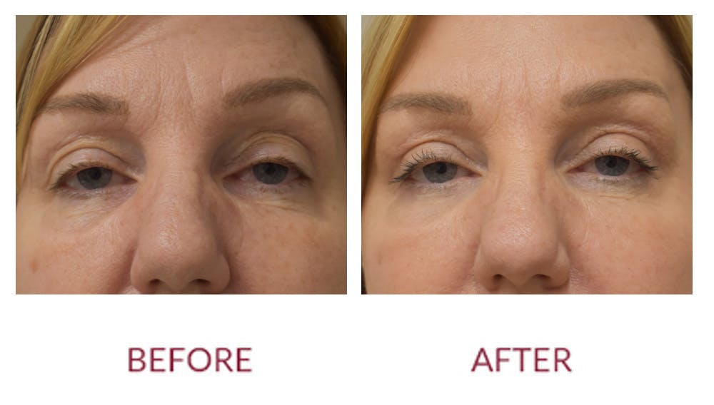 Eyelid Surgery Before & After Gallery - Patient 148702417 - Image 1