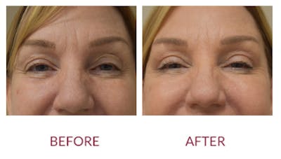 Eyelid Surgery Before & After Gallery - Patient 148702417 - Image 2