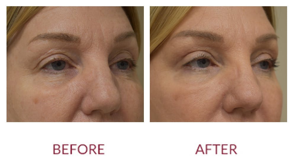 Eyelid Surgery Before & After Gallery - Patient 148702417 - Image 3