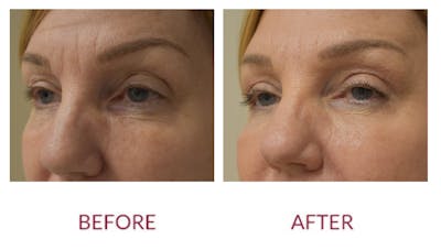 Eyelid Surgery Before & After Gallery - Patient 148702417 - Image 4
