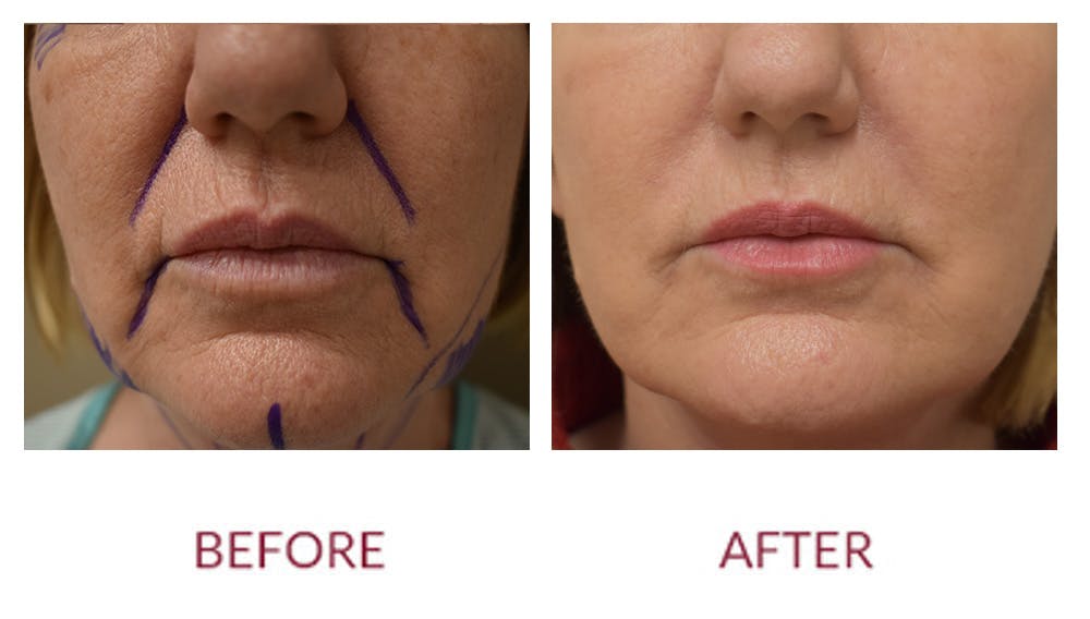 Nasolabial Fold Before & After Gallery - Patient 148702421 - Image 1