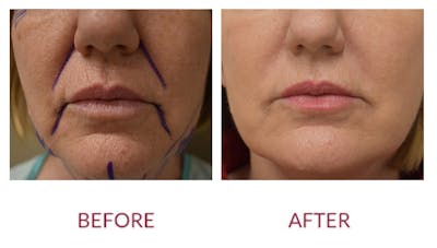 Nasolabial Fold Before & After Gallery - Patient 148702421 - Image 1
