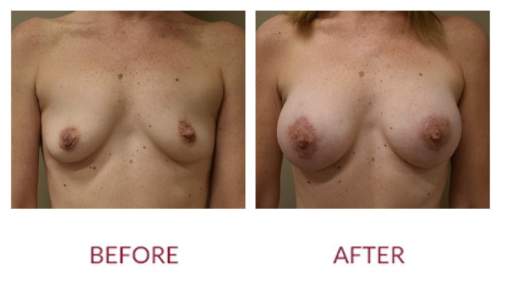 Breast Augmentation Before & After Gallery - Patient 154105745 - Image 1