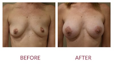 Breast Augmentation Before & After Gallery - Patient 154105745 - Image 1