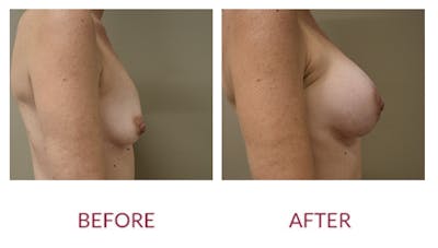 Breast Augmentation Before & After Gallery - Patient 154105745 - Image 2