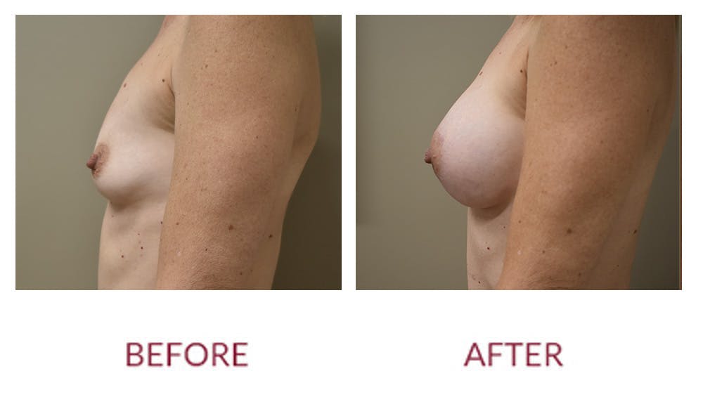 Breast Augmentation Before & After Gallery - Patient 154105745 - Image 3