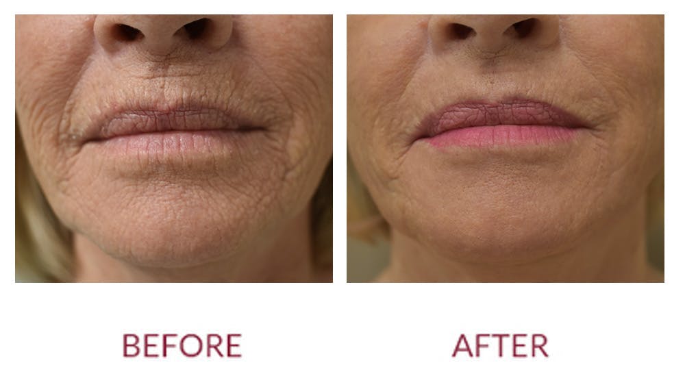 Co2 Laser Resurfacing Before & After Gallery - Patient 154105749 - Image 1