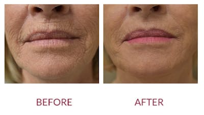 Co2 Laser Resurfacing Before & After Gallery - Patient 154105749 - Image 1