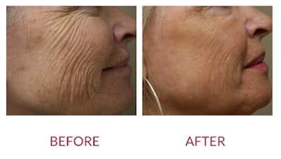 Co2 Laser Resurfacing Before & After Gallery - Patient 154105749 - Image 2