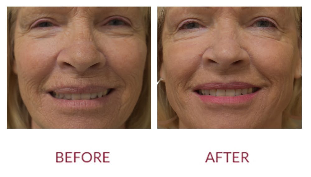 Co2 Laser Resurfacing Before & After Gallery - Patient 154105749 - Image 3