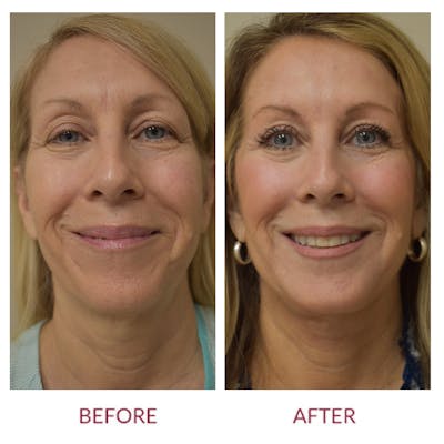 Facelift Before & After Gallery - Patient 154105752 - Image 1