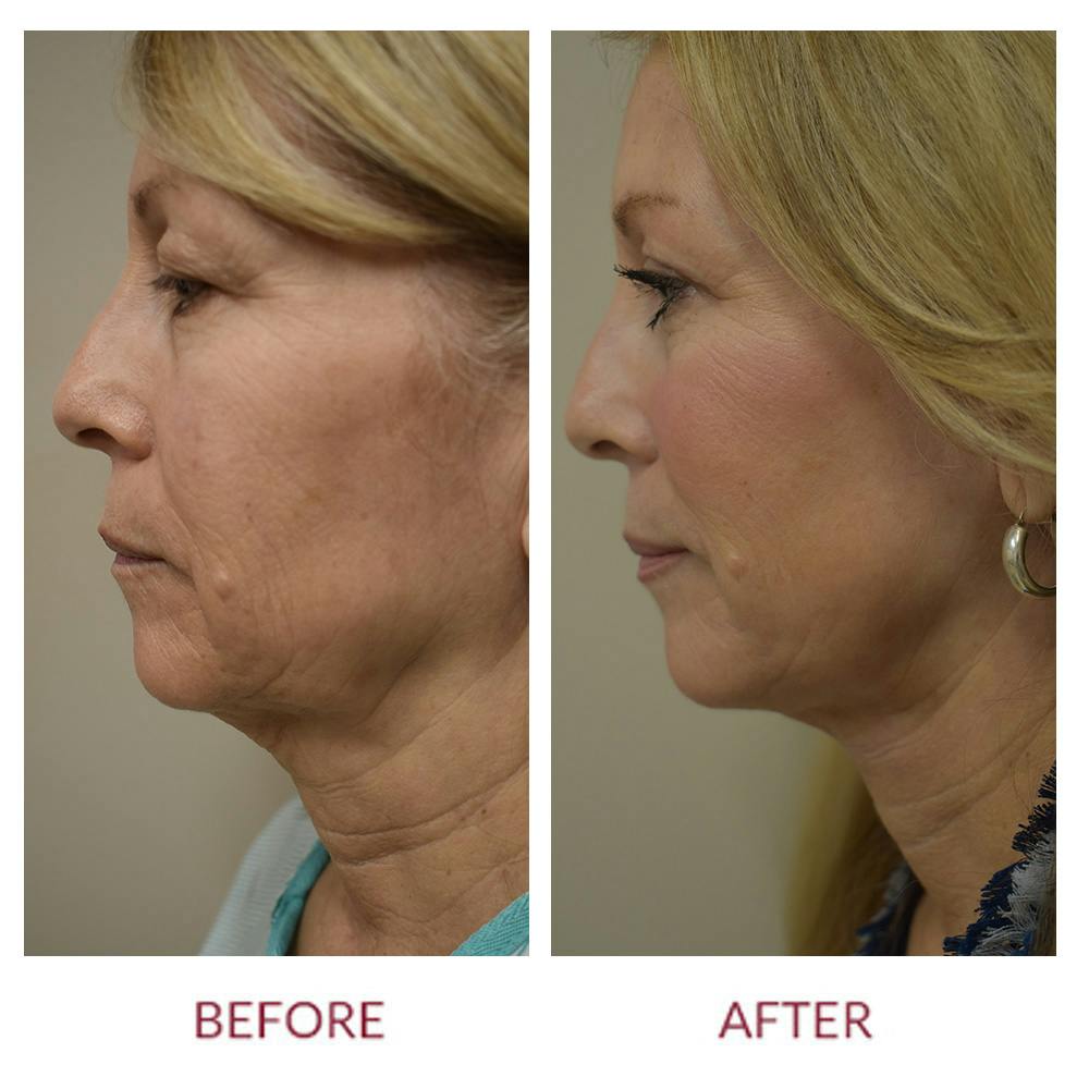 Facelift Before & After Gallery - Patient 154105752 - Image 2