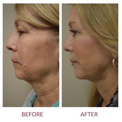 Facelift Before & After Gallery - Patient 154105752 - Image 2