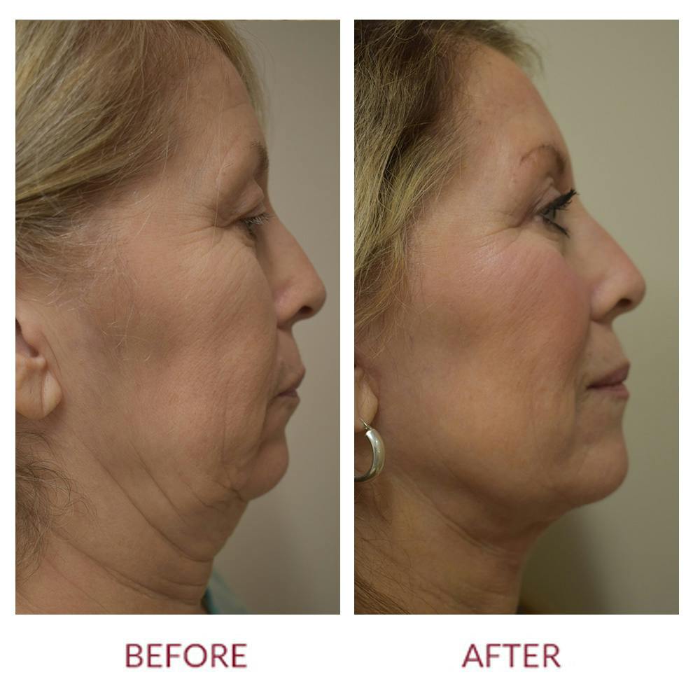 Facelift Before & After Gallery - Patient 154105752 - Image 3