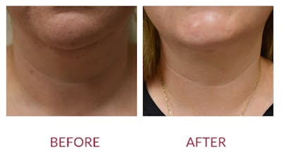 Liposuction Before & After Gallery - Patient 154105782 - Image 2