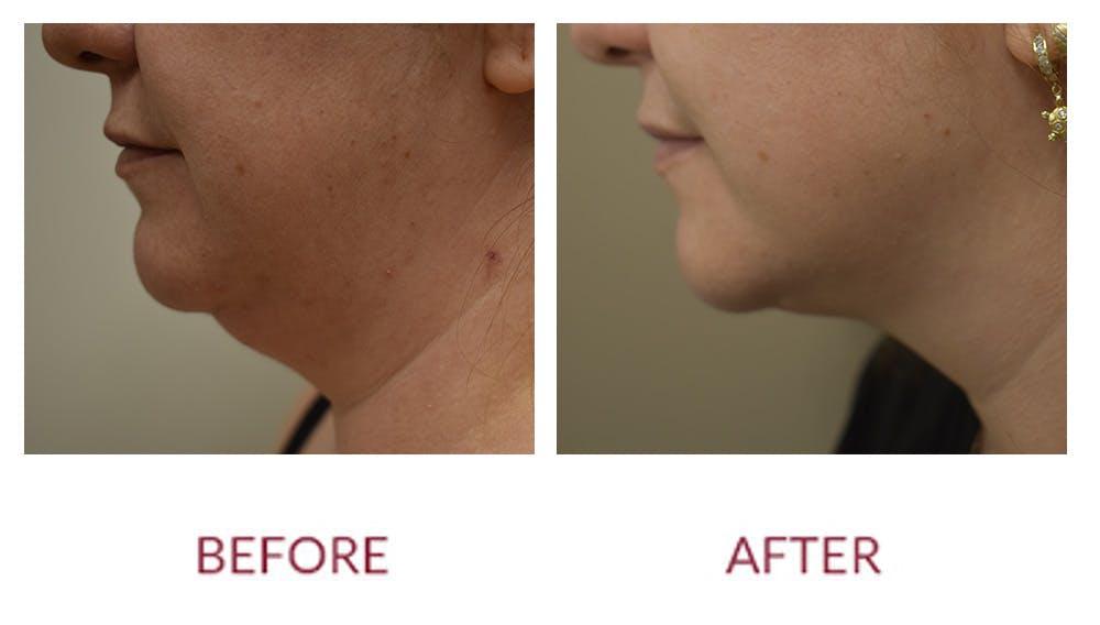 Liposuction Before & After Gallery - Patient 154105782 - Image 1