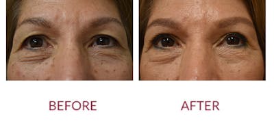 Eyelid Surgery Before & After Gallery - Patient 121753 - Image 1