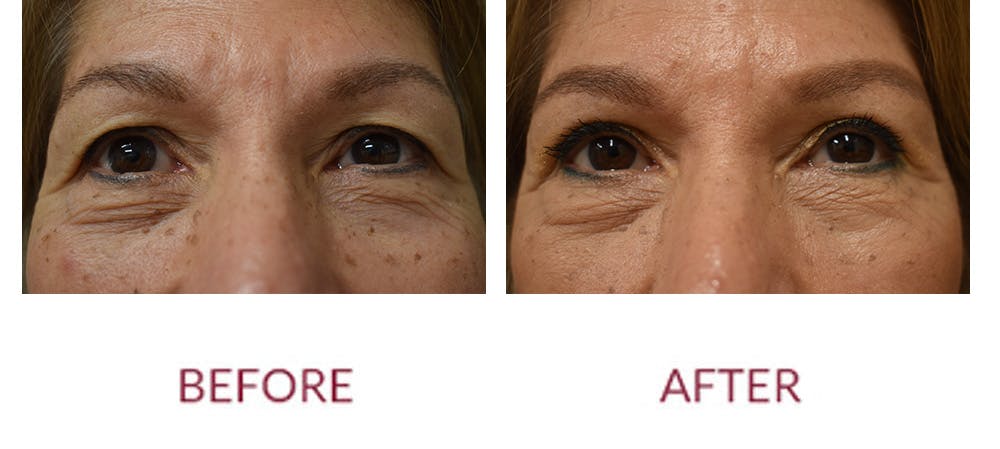 Eyelid Surgery Before & After Gallery - Patient 121753 - Image 1
